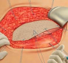 Cook® Biodesign® 8-Layer Hernia Graft