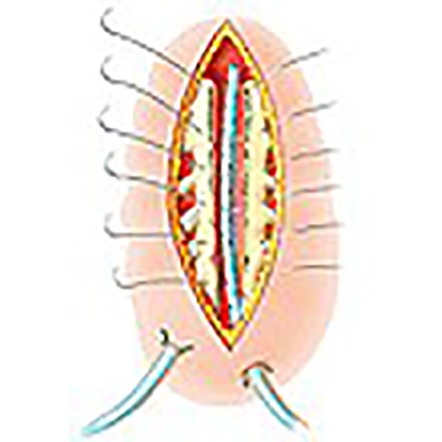 Péters Surgical Acier Sutures