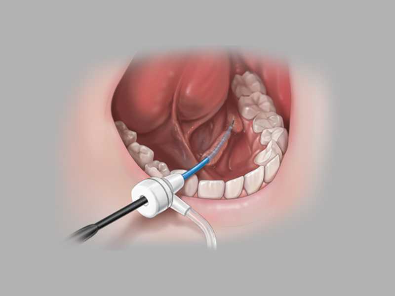 Advance® Salivary Duct Balloon Catheter Set