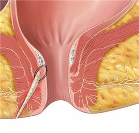 Cook® Biodesign® Anal Fistula Plug