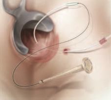 Cook® Biodesign® Fistula Plug Set