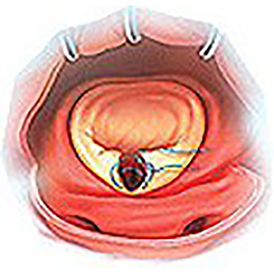 Péters Surgical Cardionyl® Sutures