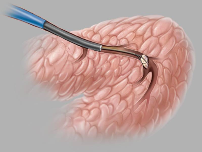 Cook NGage Salivary Stone Extractor Diagram