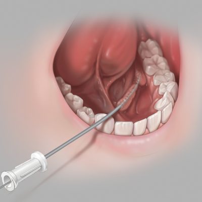 Cook® Sialendoscopy Dilator Set