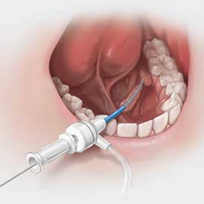 Cook® Sialendoscopy Kolenda Introducer Sheath