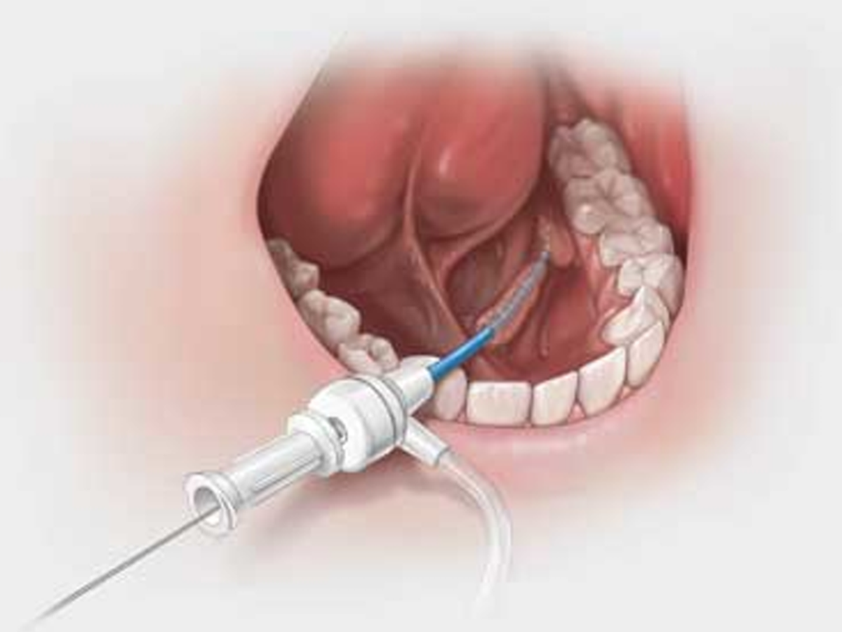 Cook® Sialendoscopy Kolenda Introducer Sheath