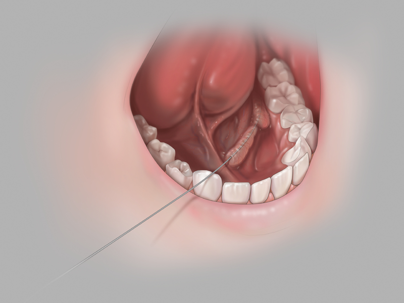 Cook® Sialendoscopy Wire Guide