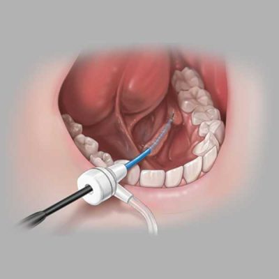 Kolenda Salivary Access Introducer Set