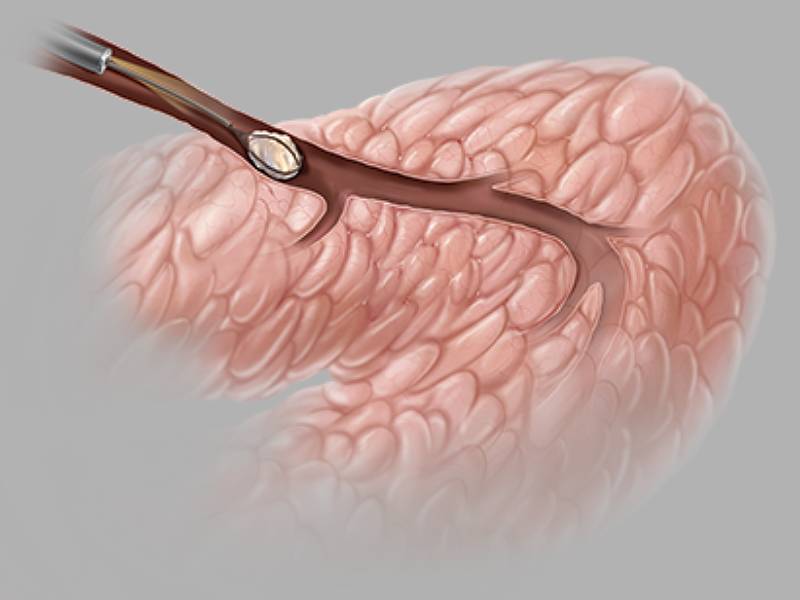 NCircle Tipless Salivary Stone Extractor Diagram