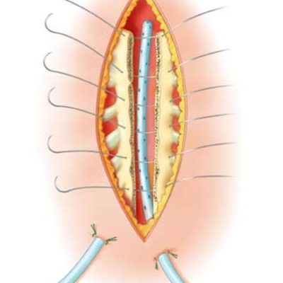 Péters Surgical Acier Sutures
