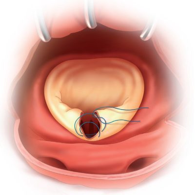 Péters Surgical Cardionyl® Sutures