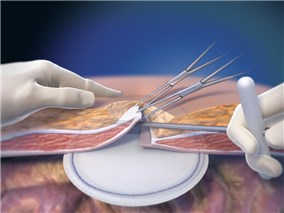 Ventrio St Hernia Patch Ventrio St Hernia Patch