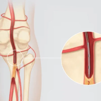 Cook® CrossCath™ Support Catheter