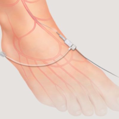 Cook® Micropuncture® Pedal Access Set
