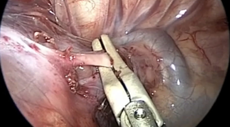 JustRight™ 3mm Vessel Sealing System - Image 5