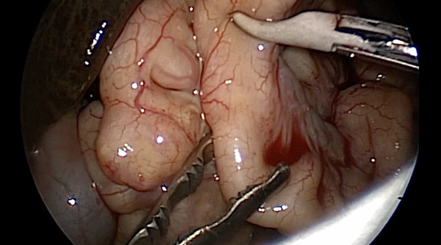 JustRight™ 3mm Vessel Sealing System - Image 6