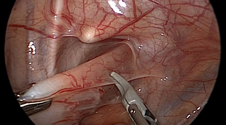 JustRight™ 3mm Vessel Sealing System - Image 7