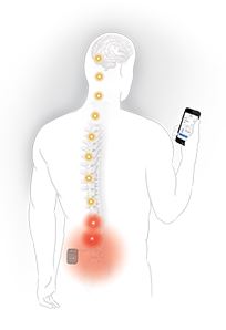Invisible Trial System for SCS and DRG
