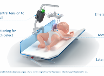 Fasciotens® Abdominal Wall Solutions – Paediatric