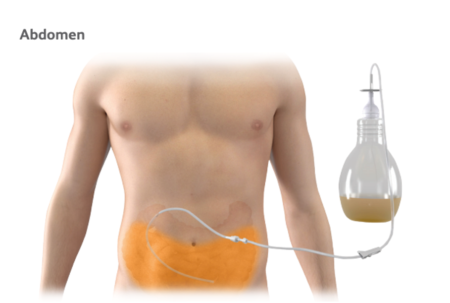 PeritX™ Peritoneal Catheter System Obex
