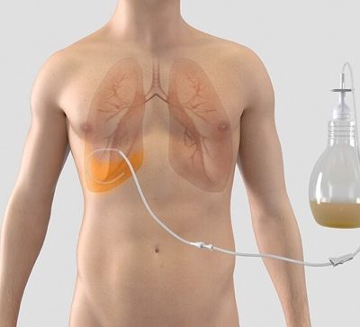 PleurX™ Pleural Catheter System