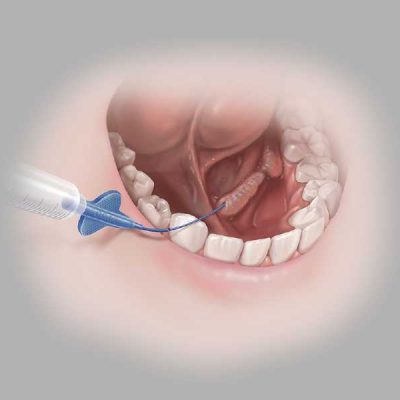 SialoCath® Salivary Duct Catheter