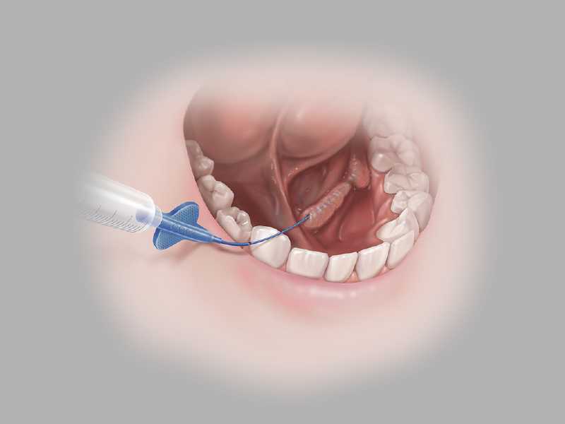 SialoCath® Salivary Duct Catheter